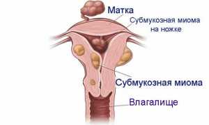 Миома матки и беременность: возможно ли зачатие и в чем опасность